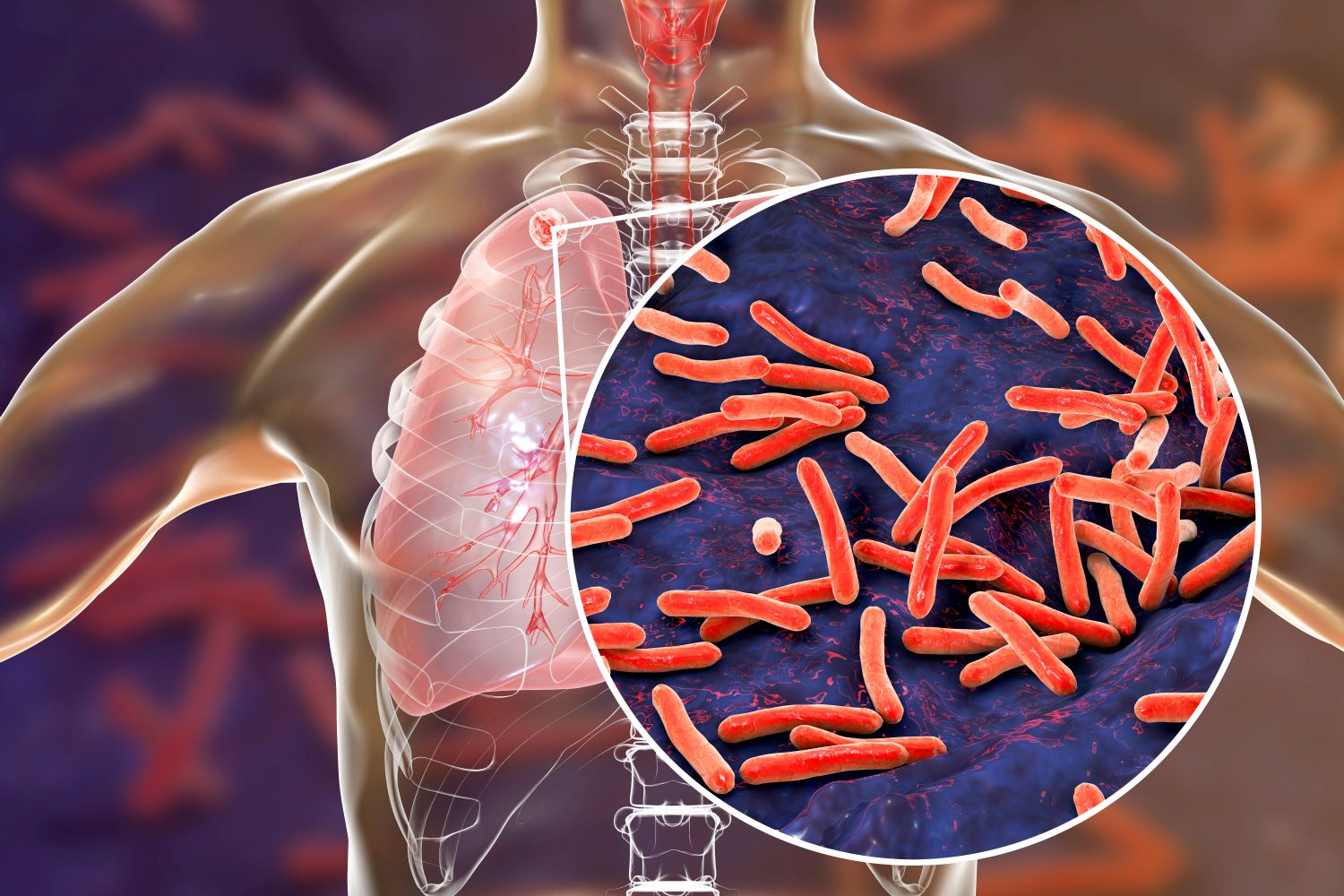 tuberculosis in the lung