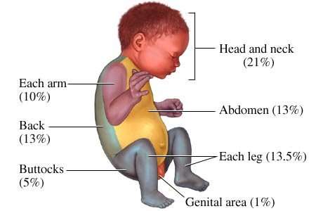 Rule of Nine for Infant:Head and Neck 21%Each Arm 10%Abdomen 13%Each Leg 13.5%Genital Area 1%Back 13%Buttocks 5%