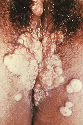 image of chancre on genitals