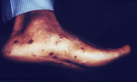 image of rash