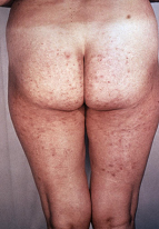 image of rash